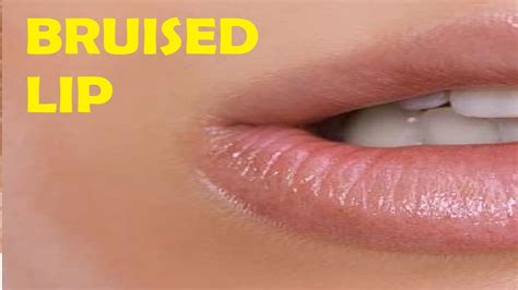 How to get rid of a bruised lip from kissing